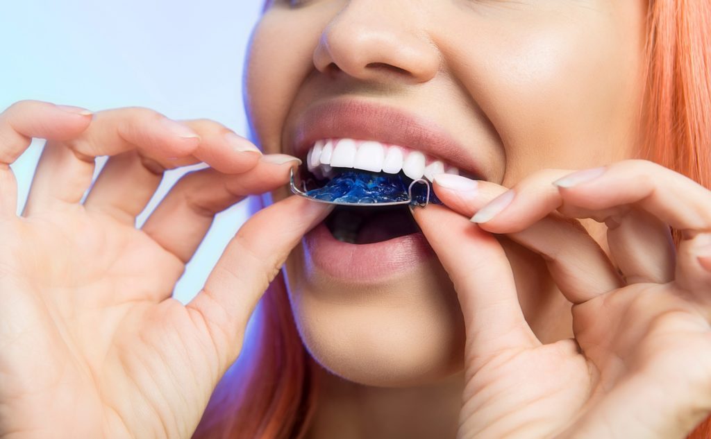 Woman placing blue retainer over her teeth